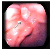 Vizualizarea endoscopica a ulcerului gastric